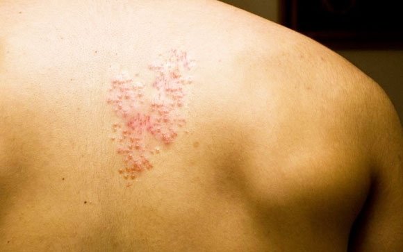  Post Herpetic Neuralgia 
